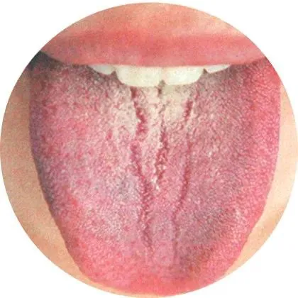 裂痕中一般无舌苔覆盖，是精血亏虚的表现。
