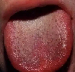 绛舌